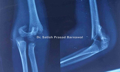 Case 5: Gartland Type III Supracondylar Humerus Fracture Treated with Closed Reduction and Pinning
