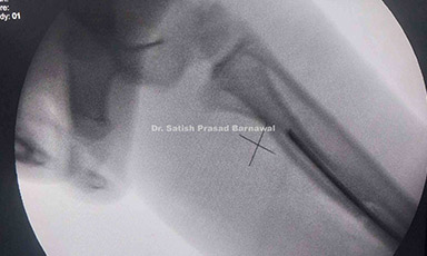 Case 5: Radius and Ulna Displaced Fracture in a Child Treated with Rush Pin Fixation