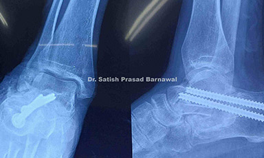 Case 5: Malunited Calcaneal Fracture with Subtalar Arthritis Treated with Subtalar Arthrodesis