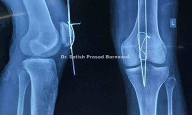 Case 5: Patella Fracture Treated with Tension Band Wiring
