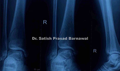 Case 5: Union of Open Middle-Distal Third Tibia Fracture with Medial Malleolus Fracture Treated with Nailing and K-Wire