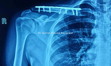 Case 5: Displaced Clavicle Fracture Treated with Plating