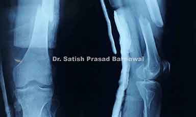 Case 5: Open Distal Third Shaft of Femur Fracture Treated with Debridement, Irrigation, Exploration and Primary Nailing