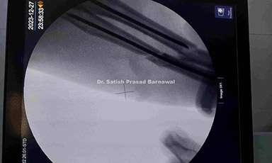Case 6: Delayed Presented Compartment Syndrome Forearm with Segmental Radius Fracture with Ulna Fracture Treated with Rush Pin fixation