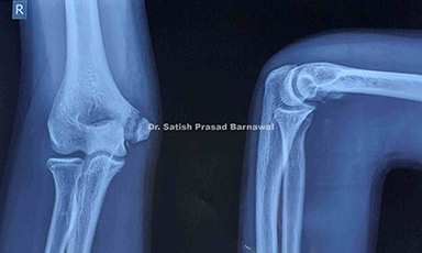 Case 6: Medial Epicondyle Humerus Fracture Treated with Tension Band Wiring