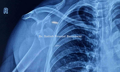 Case 6: Shoulder Dislocation Treated with Closed Reduction