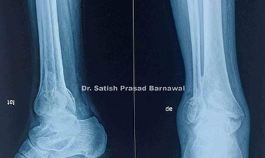 Case 6: Trimalleolar Fracture Treated with TBW for Medial Malleolus and Plating for Lateral Malleolus