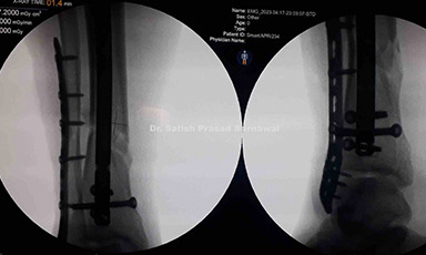 Case 6: Open Distal Third Tibia and Fibula Fracture Treated with Nailing and Plating Respectively