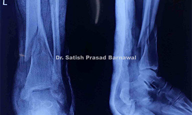 Case 7: Distal Third Tibia Fracture Treated with Anterolateral Plating of Distal Tibia