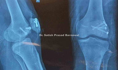 Case 7: Open Lateral Condyle Femur Fracture with Patella Fracture Treated with Debridement, Irrigation, Exploration and Screw Fixation
