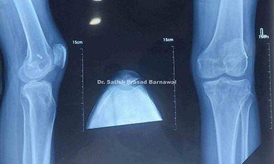 Case 7: Distal Third Tibia Fracture Treated with Closed Reduction and Nailing