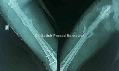Case 7: Nail Failure Femur Fracture Treated with Difficult Implant Removal and Re-fixation