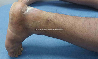 Case 8: Open Tendo Achilles Injury Treated with Staged Treatment