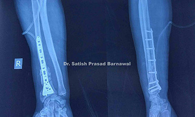 Case 1: Broken Plate with Distal Radius Fracture Treated with Implant Removal, Bone Grafting and Re-fixation with Plate and Screws