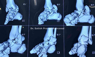 Case 1: Displaced Talus Fracture Treated with Open Reduction and Fixation with Screws