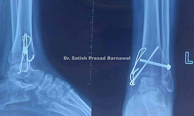 Case 2: Tillaux Fracture Associated with Medial Malleolus Fracture Treated with Open Reduction and Internal Fixation
