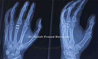 Case 1: Third Metacarpal Head Fracture Treated with Screw fixation