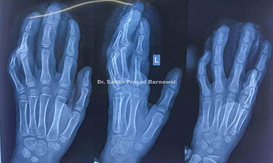 Case 3: Finger Tips Crush Injury: Salvaged Finger Tips