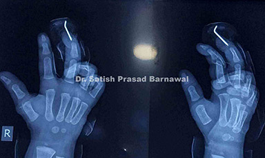 Case 4: Fingertip Crush Injury: Salvaged