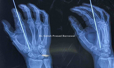 Case 7: EXtensor Tendon Injury with Second Metacarpal Fracture Treated with Pinning and Tendon Repair