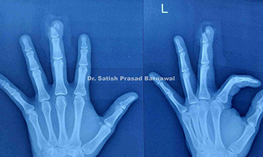 Case 8: Finger Tip Crush Injury in Adult: Salvaged