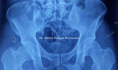 Case 3: Right Multifragmentary Sub-trochanteric Femur Fracture Treated with Closed Reduction and PFN Fixation