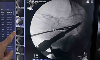 Case 1: Right Intertrochanteric Femur Fracture Treated with DHS