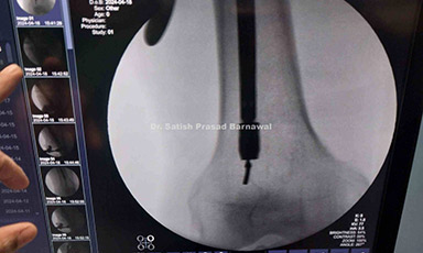 Case 2: Right Multifragmentary Sub-trochanteric Femur Fracture Treated with PFN