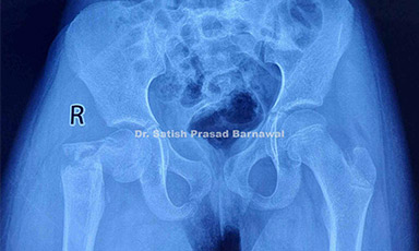 Case 4: Complex Pediatric Hip Fracture Treated with Open Reduction and Internal Fixation with Pediatric DHS