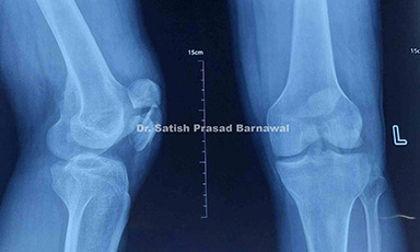 Case 5: Ipsilateral Intertrochanteric Femur and Shaft of Femur Fracture Treated with PFN