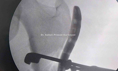 Case 6: Multifragmentary Subtrochanteric Femur Fracture Treated with Proximal Femoral Locking Plate