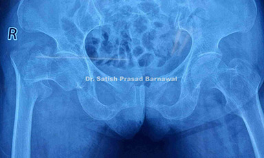 Case 7: Right Unstable Intertrochanteric Femur Fracture Treated with DHS