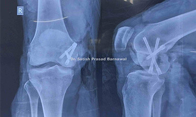 Case 6: Hoffa's Fracture Medial Condyle Femur Treated with Herbert Screw Fixation