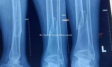 Case 4: Distal Third Tibia Fracture with Swelling and Blebs Treated with Minimal Invasive Plating after Swelling Subsided