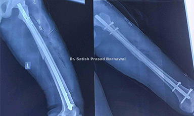 Case 1: Shaft of Femur Fracture Treated with Closed Reduction and Nailing