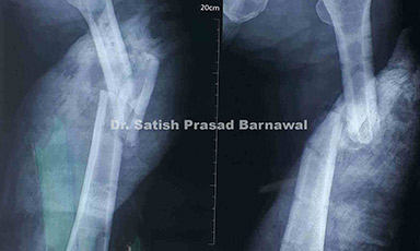 Case 2: Old Shaft of Femur Fracture with Butterfly Fragment Treated with Nailing