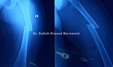 Case 3: Child with Shaft of Femur Fracture Treated with TENS