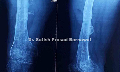Case 4: Infective Gap Non-union Shaft of Femur Fracture Treated with Plate Removal, Serial Reaming, Nailing, Bone Grafting and Bone Cement Placement