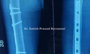 Case 8: Proximal Third Shaft of Femur Fracture in a Child Treated with Submuscular Plating