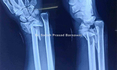 Case 4: Type 3 A Open Multi-fragmentary Distal Radius Fracture Treated with Ligamentotaxis with External Fixator