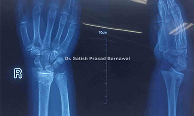 Case 5: Distal Radius Physeal Injury Treated with Closed Reduction and Pinning