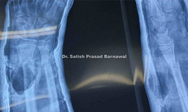 Case 6: Child with Distal Third Displaced Radius Ulna Fracture Treated with Closed Reduction and Cast Application