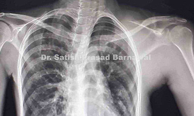 Case 2: Septic Arthritis Left Shoulder with Abscess Left Scapular Region with Cellulitis Left Upper Limb