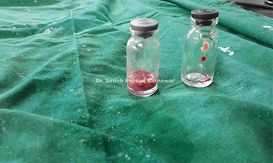 Case 4: Neonate with Septic Arthritis Right Shoulder
