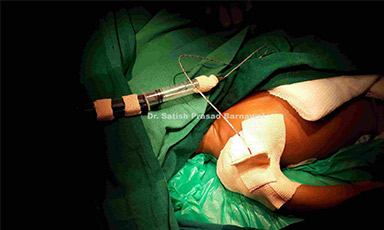 Case 3: Neonate with Septic Arthritis Right Shoulder