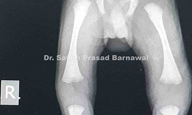 Case 6: Neonate with Left Knee Septic Arthritis