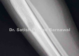 Case 2: Acute Osteomyelitis of Tibia