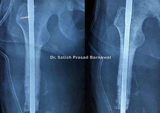 Case 1: Infective Gap Non Union of Shaft of Femur Fracture with Pus Discharge