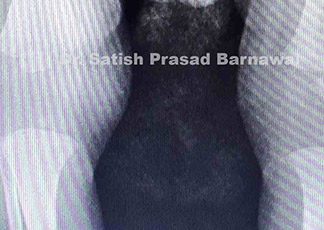 Case 7: Neonate with Septic Arthritis Knee
