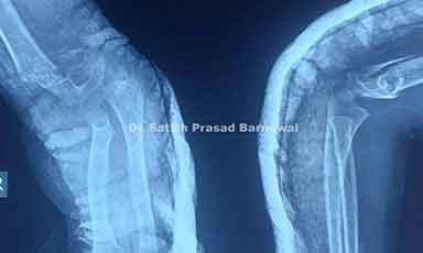 Case 2: Supracondylar Humerus Fracture Treated with Closed Reduction and Pinning
